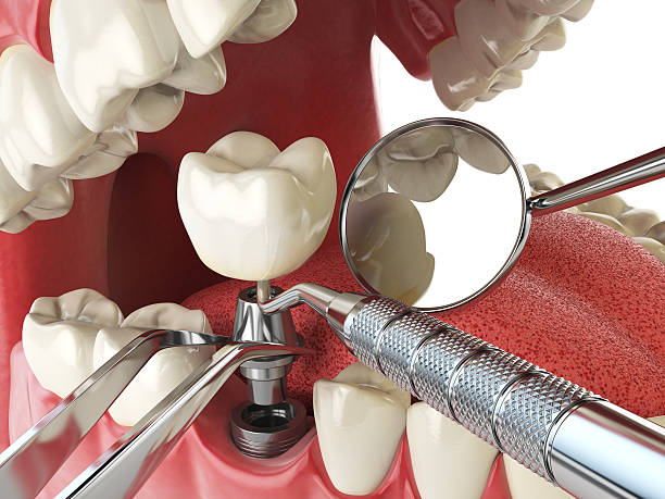 Best Emergency Dental Care for Abscessed Tooth in Hoffman Estates, IL